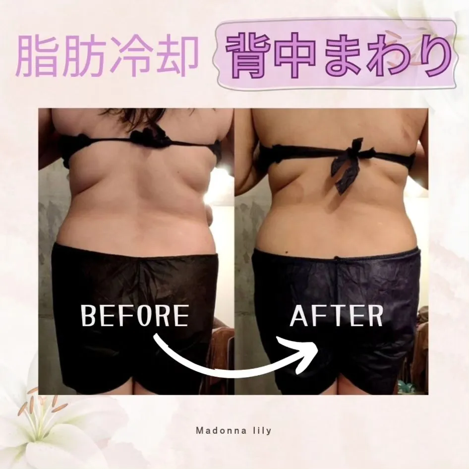 【脂肪冷却 背中まわり】